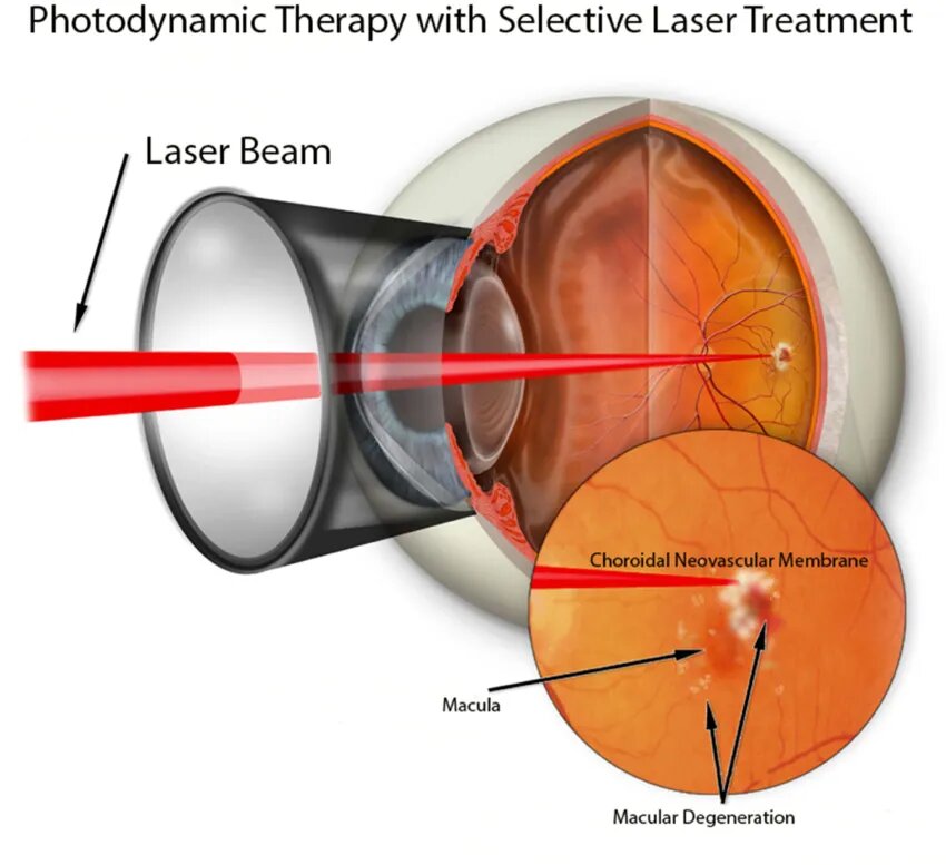 Graphic-depiction-of-light-focused-on-a-choroidal-neovascular-membrane-in-the-application Grafikmantel-acht-orientiert auf A-choroidal-neovaskuläre Membran-in-the-Application